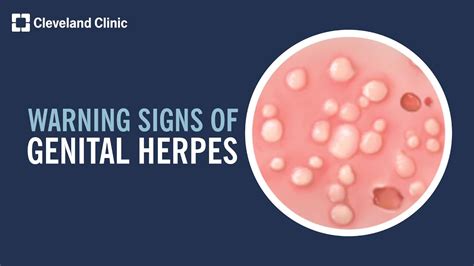 herpes in penus|Herpes on Penis and Other HSV Symptoms in Men